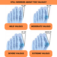 Load image into Gallery viewer, Orthopaedic Toe Bunion Corrector